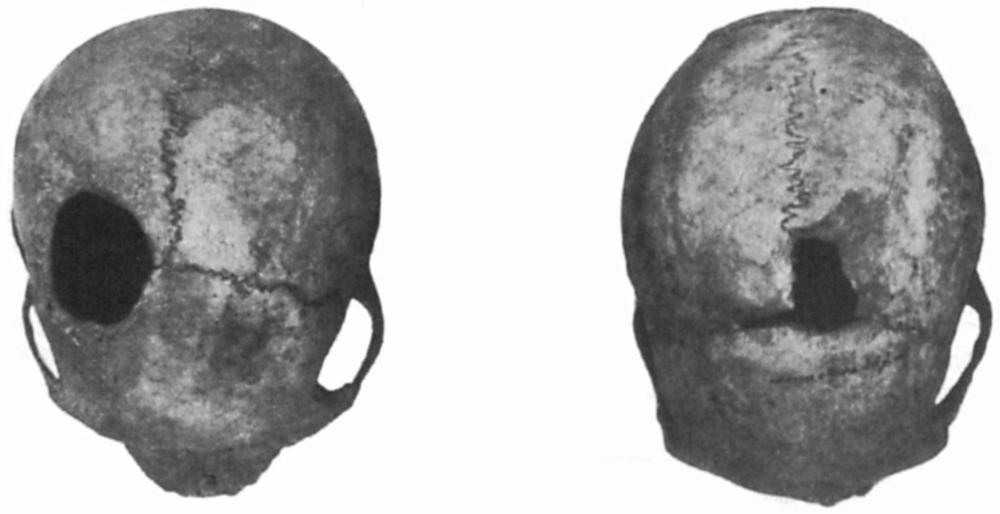 Black and white image of trepanned skulls.