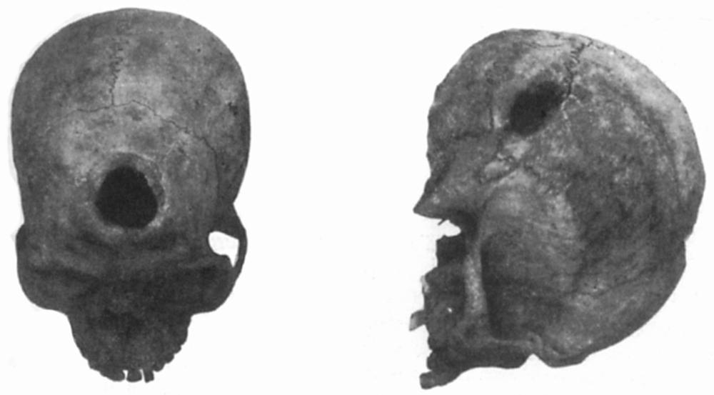 Black and white image of trepanned skulls.