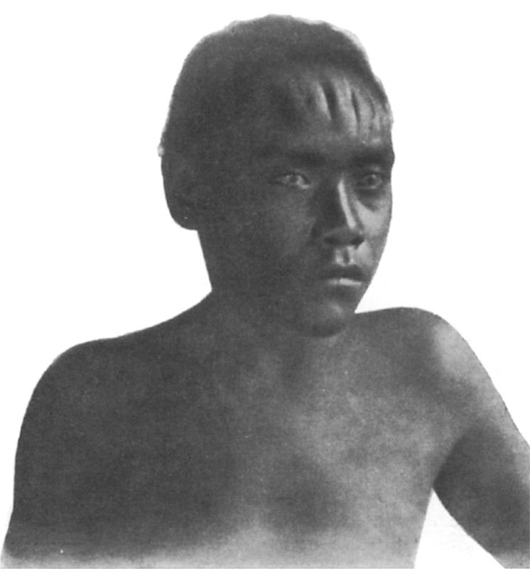 Black and white image of a boy with deep scars on his forehead.