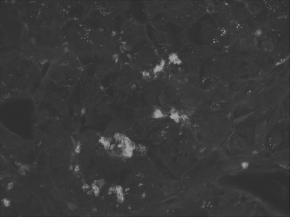 There is an image of an islet amyloid desposition in a human with type 2 diabetes. 