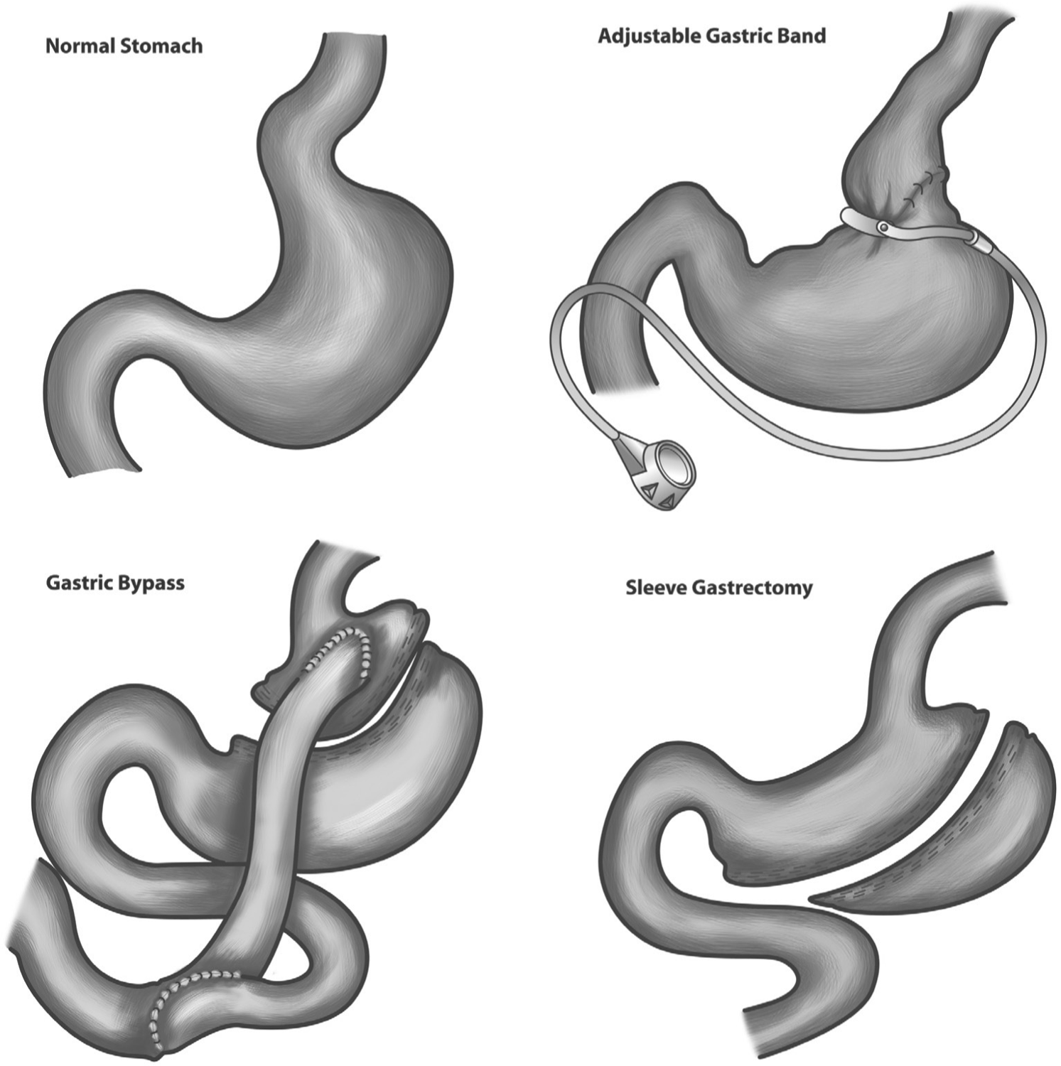 Four images showing types of barioatric surgery. The top left shows a normal stomach. The top right shows an adjustable gastric bond in which there is a band around the top of the stomach. The bottom left is gastric bypass in which there is a tube inserted that bypasses the stomach. The bottom right is a sleeve gastronomy in which part of the stomach has been seperated from the remainding stomach.